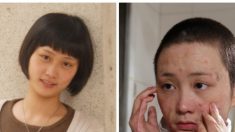 Le combat d’une jeune Chinoise défigurée par un amoureux jaloux