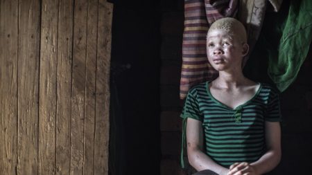 La poursuite et le meurtre rituel des albinos augmentent au Malawi