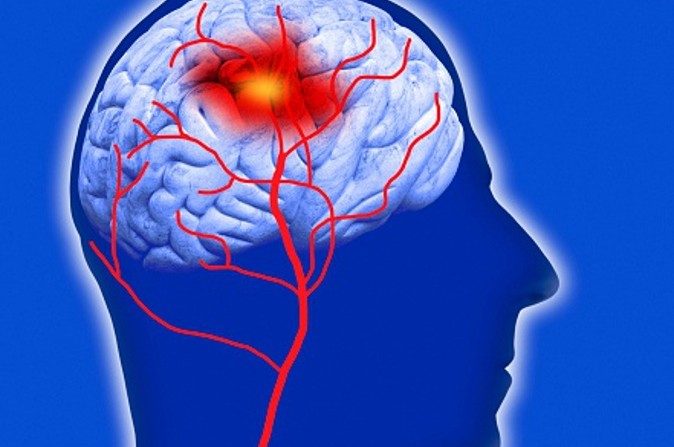 Un cerveau humain montrant une attaque. (computer artwork/Getty Images)