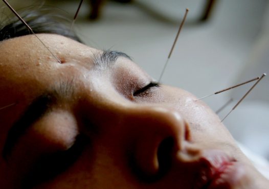 L'acupuncture utilise de petites aiguilles pour rééquilibrer le Yin et le Yang. (China Photos/Getty Images)
