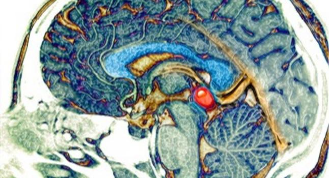 La glande pinéale dans le cerveau humain. (Living Art Enterprises/Getty Images)