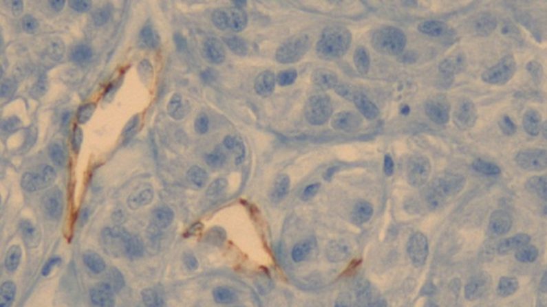 Coupe d'une tumeur observée avec un microscope optique. Les deux formes blanches au pourtour marron sont des vaisseaux sanguins. A l'intérieur, des nanoparticules d’or s'accumulent contre leur paroi. Mariana Varna-Pannerec (ESPCI)