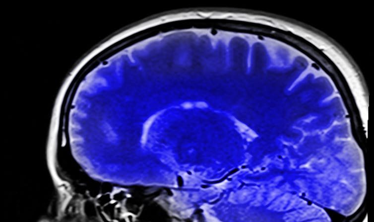 Cliché du cerveau obtenu par IRM. (Kai Stachowiak)