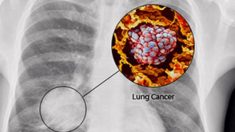 8 symptômes du cancer du poumon chez les femmes, dont « l’essoufflement » et la « perte de poids inexpliquée »