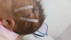 Un nouveau-né blessé par un scalpel lors de l’accouchement