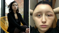 Défigurée après une simple coloration pour cheveux, une étudiante du Val-de-Marne a failli en mourir