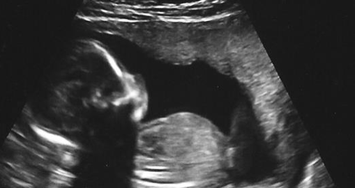Une image échographique d'un bébé à la 18e semaine de grossesse. ("Baby McBride Ultrasound 17 Weeks 6 Days (3)" par Nogwater/Flickr[CC BY-SA-2.0 (ept.ms/2utDIe9)])
