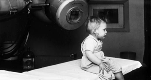 Gordon Isaacs, le premier patient traité avec l'accélérateur linéaire (radiothérapie), pour un rétinoblastome en 1957. (Domaine public)
