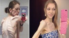 Une adolescente anorexique pesant 25kg était au bord de la mort, mais le fitness lui sauva la vie