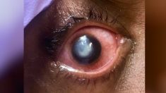 Un ophtalmologue partage des photos explicites sur les risques à dormir avec des lentilles de contact