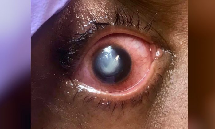 L'œil d'un patient souffrant d'une infection à pseudomonas de la cornée. (Clinique oculaire Vita)