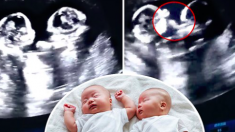 Une échographie montre un «combat de boxe hilarant» entre des jumeaux identiques dans l’utérus