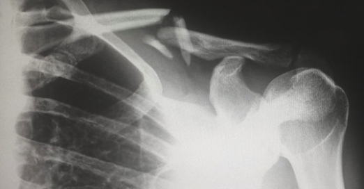 Une image montrant une scanographie d'une partie d'un squelette. (Harlie Raethel/Unsplash)