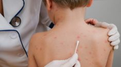 Un petit garçon ayant la varicelle pleure de douleur et maman découvre la grave erreur des médecins