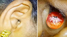 Vidéo : Le mal d’oreille d’une femme s’avère être une araignée qui s’est installée dans son oreille