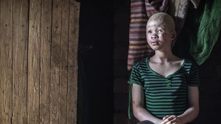 Trois condamnations à la peine capitale pour le meurtre d’un albinos au Malawi