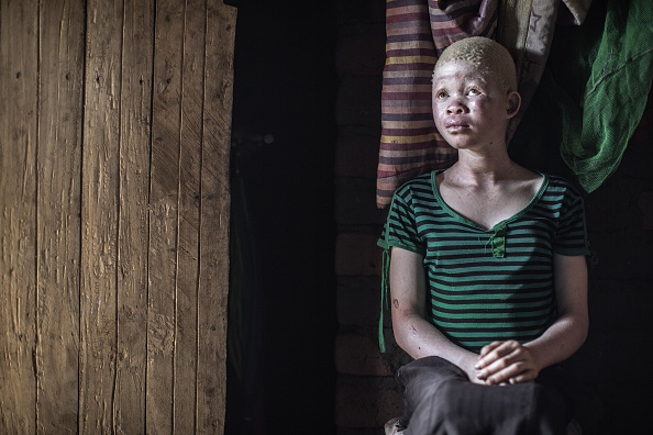 Une fillette albinos malawienne dans le quartier traditionnel de Nkole, dans le district de Machinga.  (Photo :  GIANLUIGI GUERCIA/AFP/Getty Images)