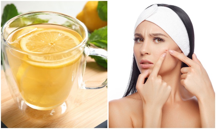 L'eau citronnée aide à résoudre de nombreux problèmes de santé, dont l'acné (New Africa/Shutterstock)