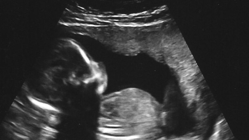 Une échographie d'un bébé à la 18e semaine de grossesse. ("Baby McBride Ultrasound 17 Weeks 6 Days (3)" par Nogwater/Flickr[CC BY-SA-2.0 (ept.ms/2utDIe9)]))