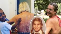 Après 47 ans de honte – Une victime de brûlures lance une campagne pour encourager les gens à entretenir une image de soi positive par rapport à leur corps : «Mes cicatrices sont merveilleuses»