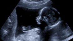 Des parents ont refusé l’avortement proposé par les médecins, leur enfant est né avec une partie du cerveau en dehors du front mais bien vivant