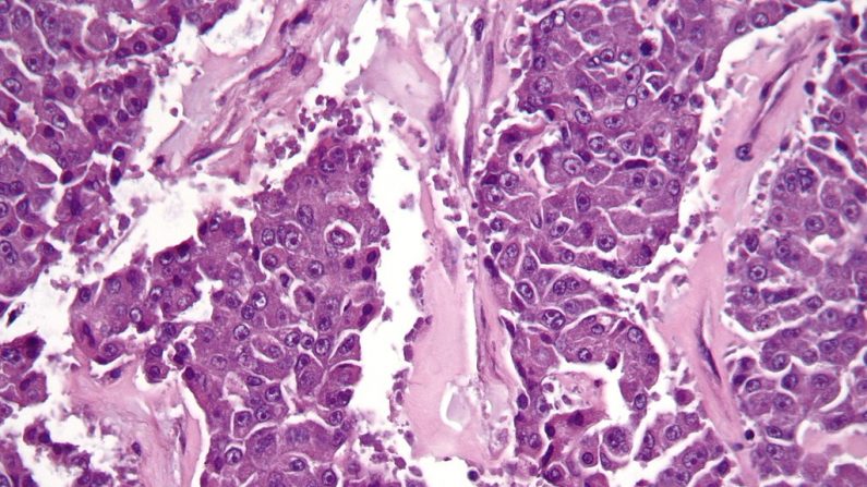 Carcinome à cellules acineuses (Nephron/Wikimedia Commons)
