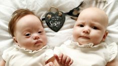 «Une chance sur un million»: l’une de ces jumelles est née avec la trisomie 21 et l’autre, sans