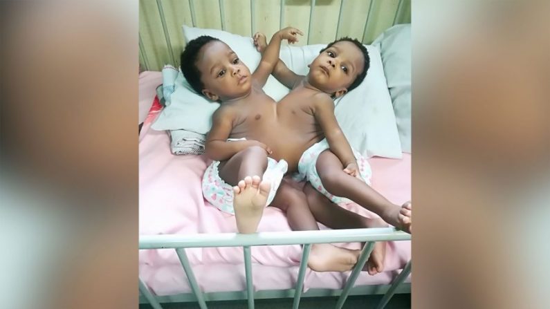 Les sœurs, Mercy et Goodness Ede, qui étaient jointes par la poitrine et l'abdomen, ont été séparées avec succès lors d'une opération par une équipe de 78 membres dans la capitale du Nigeria, Abuja. (Avec l'aimable autorisation de l'Hôpital National d'Abuja Nigeria) 