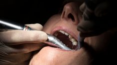 Var : 15 ans après, un retraité découvre que son ancien dentiste a oublié un instrument dans sa dent