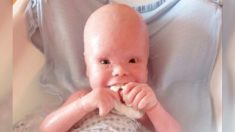 Les gens prennent cet enfant de 2 ans pour «une poupée» à cause de son problème cutané douloureux – mais sa joie de vivre demeure intarissable