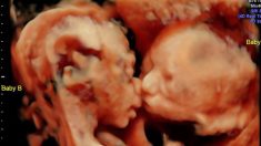 Une échographie à 24 semaines révèle des jumelles qui s’embrassent dans l’utérus, et les photos deviennent virales