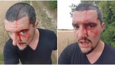 Yvelines : il fait son jogging dans les bois et se fait lacérer le crâne par une buse à deux reprises
