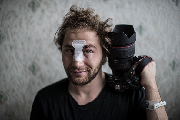 -Le photographe indépendant syrien Ameer al-Halbi, 24 ans, blessé lors d'affrontements lors d'une manifestation contre le projet de loi sur la « sécurité mondiale », chez lui à Paris, le 29 novembre 2020. Photo par Sameer Al-Doumy / AFP via Getty Images.