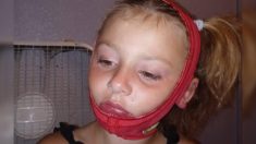 Du gel hydro-alcoolique s’enflamme et brûle gravement le visage d’une petite fille