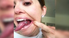 Une femme pensait que sa douleur à la langue était due à une morsure, jusqu’à ce que le médecin lui annonce une mauvaise nouvelle