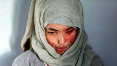 Défigurée à l’acide, Al-Anoud, 19 ans, visage des femmes brutalisées au Yémen