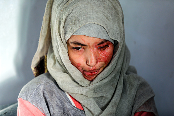 -Mariée à l'âge de 12 ans, rejeté à 16 ans, puis défiguré dans une attaque à l'acide. Photo de Mohammed Huwais / AFP via Getty Images.