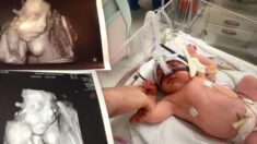 Les poumons d’un nourrisson de 22 mois se sont affaissés alors qu’ils étaient envahis de kystes depuis sa naissance – mais grâce à des agents de santé, il se porte bien