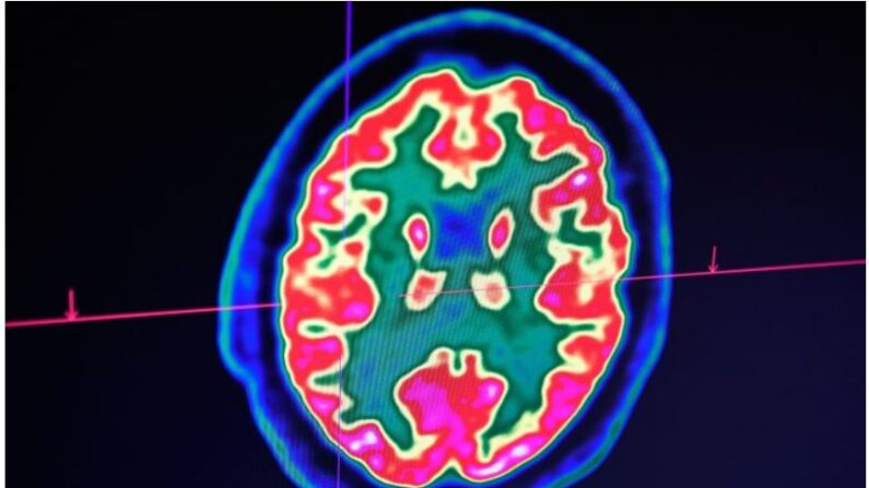 Cette image d'archives montre une photo d'un cerveau humain prise par un scanner de tomographie par émission de positrons, également appelé PET scan, sur un écran au Centre hospitalier régional et universitaire de Brest, dans l'ouest de la France, le 9 janvier 2019. (Fred Tanneau/AFP/Getty Images)