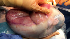 Un moment magique: la naissance d’une jumelle à l’intérieur du sac amniotique, un cas rare, 1 sur 80.000
