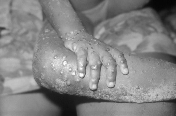 -Le Centre de contrôle des maladies, des lésions ressemblant à la variole du singe sont montrées sur le bras et la jambe d'une fille à Bondua, au Libéria. Photo Courtesy of the CDC/Getty Images.