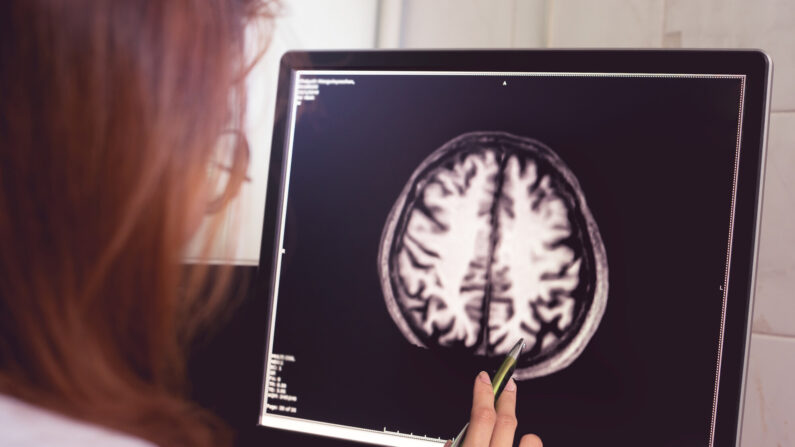 L'IRM (image par résonnance magnétique) du cerveau d'un patient atteint de démence et présentant une asymétrie de l'atrophie pariétale gauche. (Par Atthapon Raksthaput/Shutterstock)