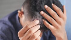 Une étude établit un lien entre l’infection au Covid-19 et une chute de cheveux importante