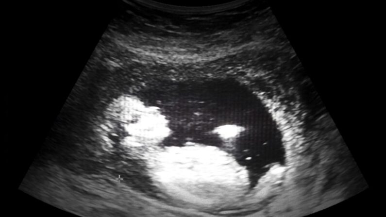 Photo d'archive d'une échographie d'un fœtus de 13 semaines. (Kornn Photo/iStock)