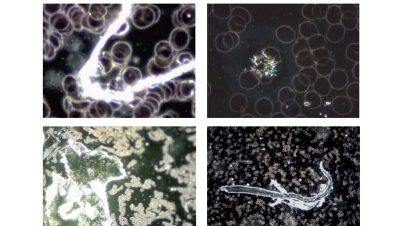 Ces 4 images illustrent la variété de phénomènes et de corps inhabituels trouvés dans le sang de sujets vaccinés avec Comirnaty BioNTech/Pfizer (avec l'aimable autorisation de Helen Krenn).