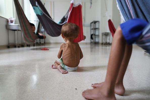 Un bambin du peuple Yanomami souffrant de malnutrition en traitement à l'hôpital pour enfants Santo Antonio à Boa Vista, au Brésil, le 27 janvier 2023.  (Photo : MICHAEL DANTAS/AFP via Getty Images)