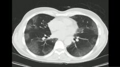 Les spécialistes tentent d’expliquer les poumons blancs en Chine: «Cela n’a aucun sens»