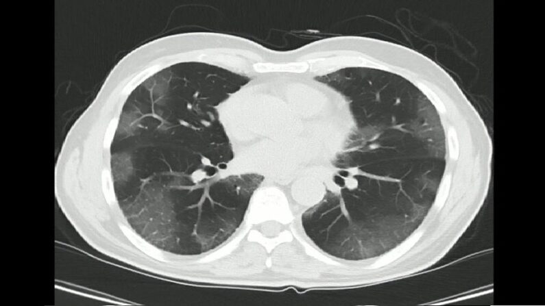 Tomodensitométrie des poumons dans un cas confirmé de Covid-19. (Shutterstock)