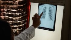 Europe : le nombre de morts dues à la tuberculose remonte, selon l’OMS