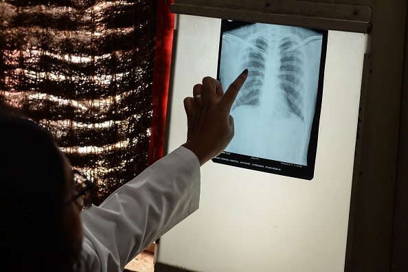 Un médecin vérifie la radiographie du thorax d'un patient dans le service de la tuberculose. Illustration (NOAH SEELAM/AFP via Getty Images)